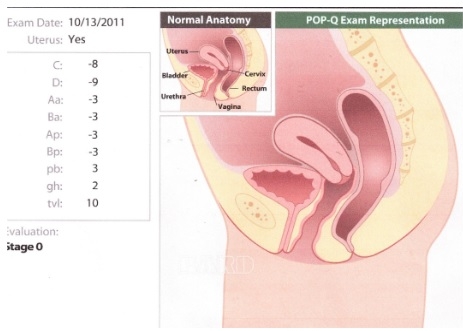 prolasso della vescica