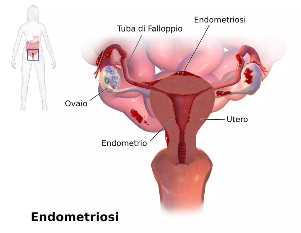 Endometriose
