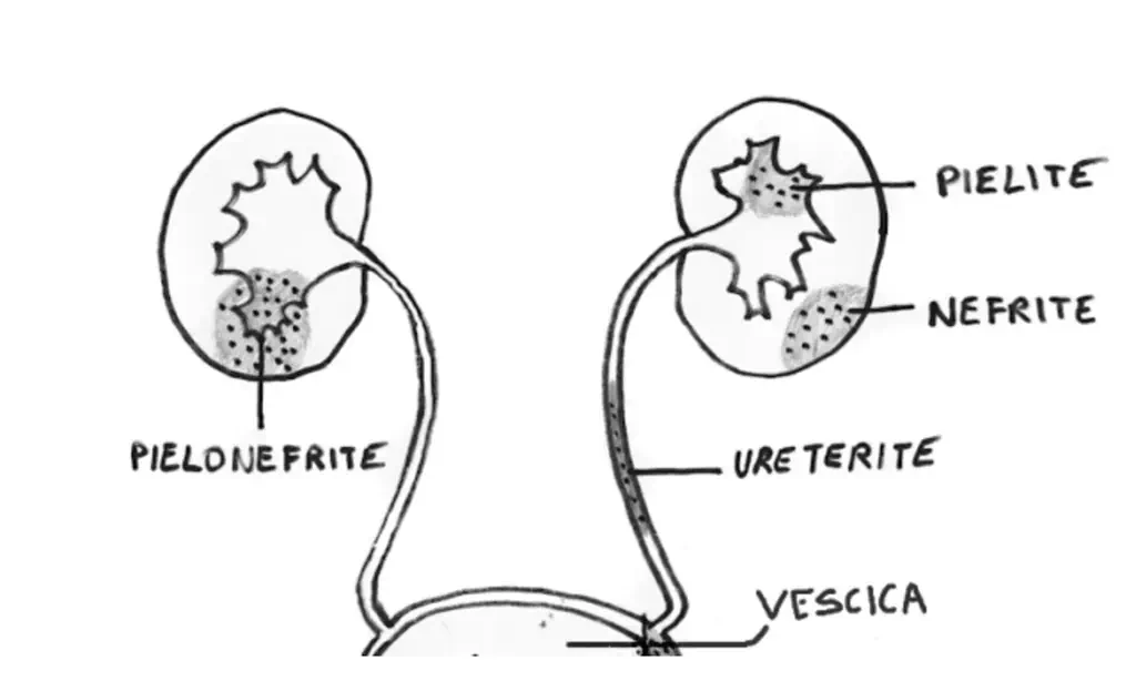 Nefrite e pielonefrite causate da cistite