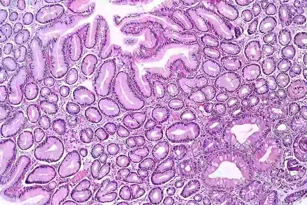 Metaplasia della vescica