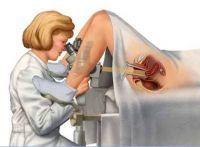 colposcopia 1 1404127007