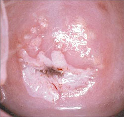 hpv displasia