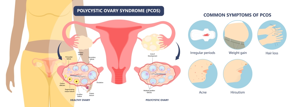 PCOS sintomi