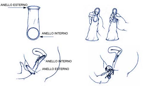 preservativo femminile