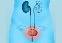 cistite vescica small