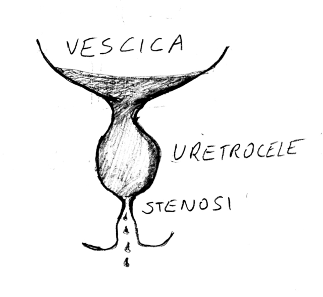 Fig. 16: Stenosi e uretrocele stenosi