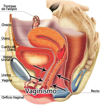 vaginismo4